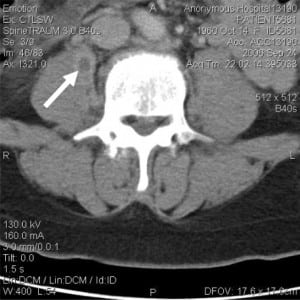 Figure 1. Non-contrast CT scan of lumbar spine with arrow pointing to abscess in right psoas muscle. Note presence of abscess in the left psoas muscle along the medial border.