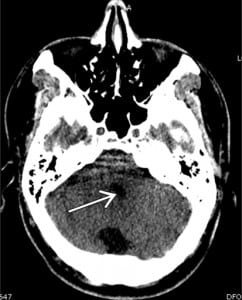 Figure 2. Normal fourth ventricle on computed tomography suggesting the hydrocephalus being related to acquired stenosis of the aqueduct of Sylvius.