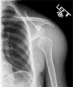 Figure 1. Radiograph of dislocation in the shoulder caused by extracapsular abscess.