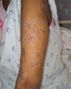 Figure 1. Upper extremity cutaneous plaque sarcoidosis
