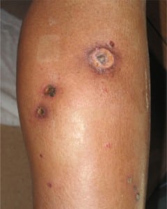 Figure 2. Lower extremity cutaneous sarcoidosis
