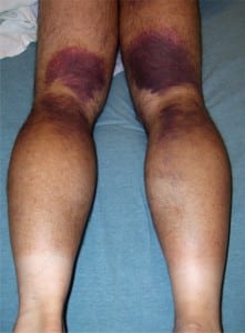 Figure 1. The pattern of ecchymoses seen over the patient’s posterior legs.