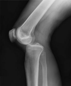 Figure 2. Plain film lateral view of left knee showing posterior knee dislocation