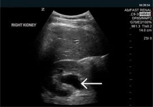 Figure 1. Central anechoic area consistent with moderate hydronephrosis of right kidney.