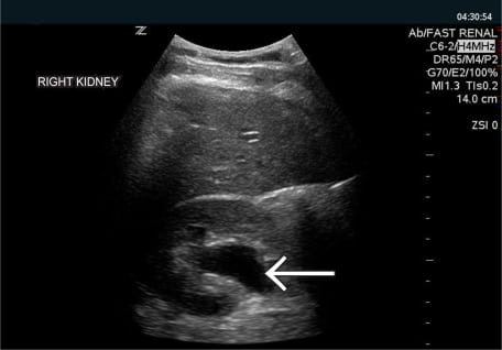 Time Course Resolution of Hydronephrosis with Spontaneous Ureteral Stone Passage