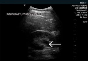 Figure 2. Mild hydronephrosis after presumed passage of obstructing ureteral calculus.
