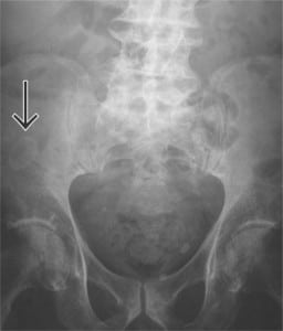 Figure. Percutaneous endoscopic gastrostomy tube in lower abdomen