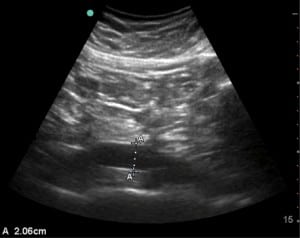 Figure 1. Longitudinal ultrasound of abdominal aorta