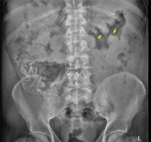 Figure 1. Plain radiograph of the abdomen showing “thumbprinting” representing significant bowel mucosal edema.