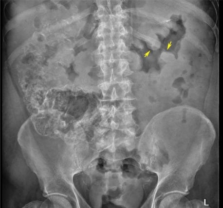 thumbprinting mesenteric abdominal ischemia colitis bowel abdomen mucosal sign radiograph plain radiography edema clues tracking prints imgur accordion showing figure