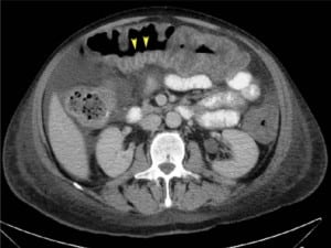 Figure 2. Computed tomography of the abdomen with oral contrast showing Accordion sign.