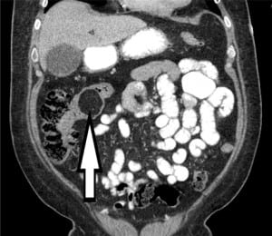 Figure 1. Coronal computed tomography image of the patient’s abdomen and pelvis demonstrating the intestinal lipoma (arrow) and the subsequent ileocecal intussusception (left of arrow).
