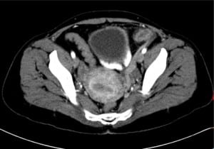 Figure 1. Transverse computed tomography of left-sided appendicitis