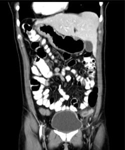 Figure 2. Coronal computed tomography of left-sided appendicitis