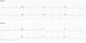 Figure 1. Electrocardiograms (ECGs) from Subject 10 showing non-specific inferior T wave changes (before and after ECGs).