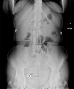 Figure 1. Upright (left) and supine (right) abdominal radiographs demonstrating retained capsule endoscope.