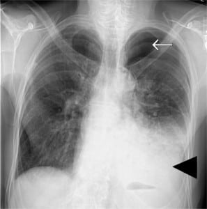Figure 1. Radiograph of left-sided pneumo-hydrothorax, where the black arrowhead indicates the hydrothorax and the white arrow indicates the pneumothorax.