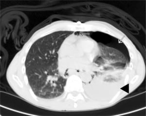 Figure 2. Computed tomography of the chest with pneumo-hydrothorax and mediastinal air, where the black arrowhead indicates the hydrothorax, the white arrow indicates the pneumothorax, and the black arrow indicates the mediastinal air.