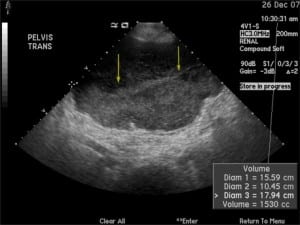 Figure 1. Pelvic ultrasound showing a complex fluid collection in the pelvis. Arrows denote the complex pelvic fluid collection.
