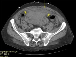 Figure 2. Noncontrast CT scan image of lower abdomen. Arrow points to thickened left rectus muscle and sheath. Arrowheads point to the complex heterogeneous collection posterior to the anterior abdominal wall.