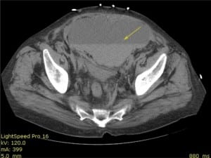 Figure 3. Noncontrast CT scan image of pelvis. Arrows denote complex fluid collection with layering consistent with hematoma.