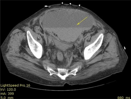 health form ct The  Hematoma Spontaneous Sheath Western Rectus Journal