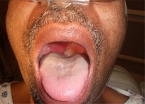Figure 1. Oropharynx of patient showing hydropic uvula deviated leftward by right peritonsillar abscess.
