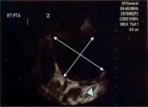 Figure 2.Intraoral ultrasound showing large black (hypoechoic) fluid collection (arrows) anterior to the carotid artery (arrowhead).