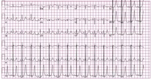 Figure 1. Initial elctrocardiogram showing left ventricular hypertrophy, hyperacute T waves, and a prolonged QT interval.