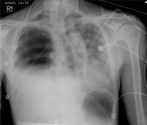 Figure 2. Portable chest x-ray demonstrating a right-sided tension hemopneumothorax