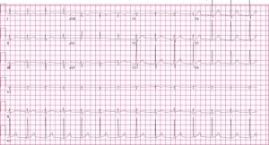 Figure 3. Repeat electrocardiogram following chest tube placement