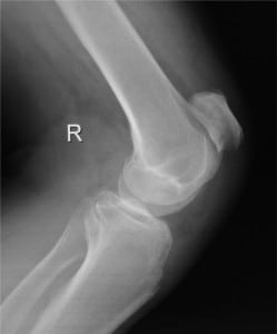 Figure 1. Lateral knee radiograph showing patella alta.