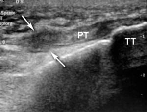 Figure 2. Ultrasound longitudinal scan over the infrapatellar region shows the complete patellar tendon rupture, which is swollen and hypoechoic (arrows). PT = patellar tendon. TT = tibial tuberosity.