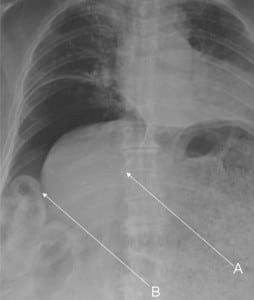 Figure. Abdominal radiograph showing football (A) and Rigler’s signs (B).