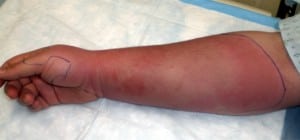 Figure. Right extremity rash