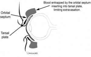 Figure 2. Drawing depicting physiology of tarsal plate sparing.