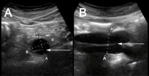 Figure 1. Emergency department ultrasound of the abdominal aorta in transverse (A) and longitudinal (B) axis.