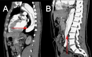 Figure 2. Sagittal computed tomography images demonstrating the thoracic (A) and abdominal (B) portions of the involved dissecting aorta with arrows indicating the dissecting intimal flap.