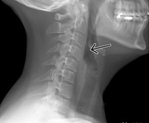 Figure 1. Lateral soft tissue neck radiograph revealing a needle-shaped foreign body.