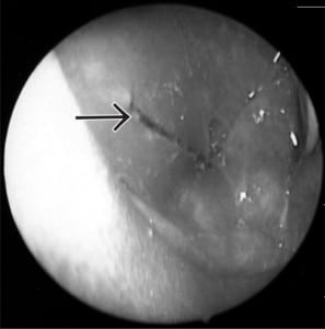 Figure 2. Fiberoptic laryngoscopy shows a 3.3 cm metallic foreign body in the esophagus.