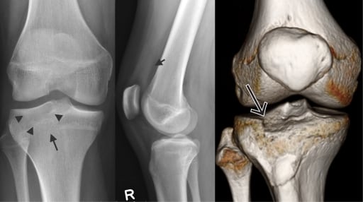 Radiographic Signs of Type 3A Schatzker Fracture of Lateral Tibial Plateau