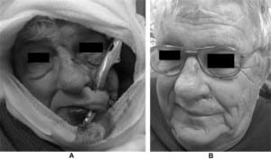 Figure 1. A 75-year-old male with bicycle brake handle impaled into his left upper lip (panel A), and following removal of the brake handle and complex suture repair of the resulting laceration (panel B).