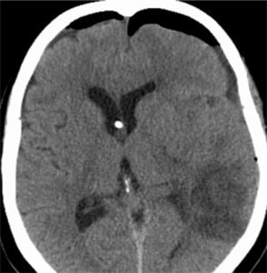 Figure 4. “Mount Fuji” sign. Axial cranial computed tomography through the level of frontal horns shows a large subdural bilateral pneumocephalus post-operatively. Note the compression of the frontal lobes and widening of the interhemispheric space between the frontal lobes, simulating the appearance of Mount Fuji.