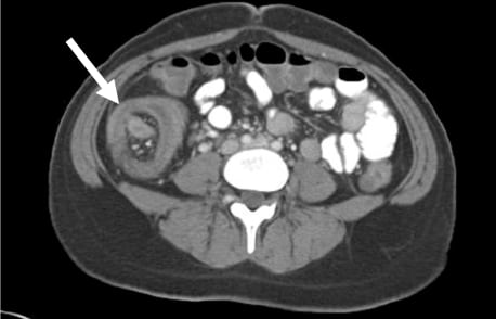 Ileocecal Intussusception in the Adult Population: Case Series of Two Patients