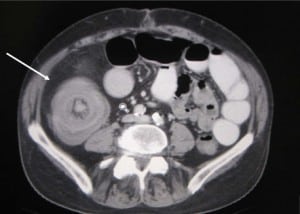 Figure 2. Ileocolic Intussusception from an adenocarcinoma causing bowel edema.