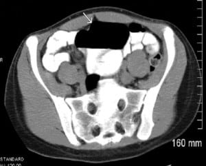 Figure 1. Computed Tomography image showing low lying cecum dilated to 8cm (arrow) but no evidence of obstruction.