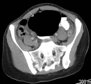 Figure 2. Repeat computed tomography scan showed marked dilatation (arrow) of the cecum up to 10.5 cm with a transition point in the right lower quadrant suspicious for obstruction and cecal volvulus.