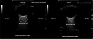 Figure 1. Ultrasound images of left (symptomatic), which failed to demonstrate a hyperechoic fluid collection in the retro-ocular region & right (asymptomatic) orbits.