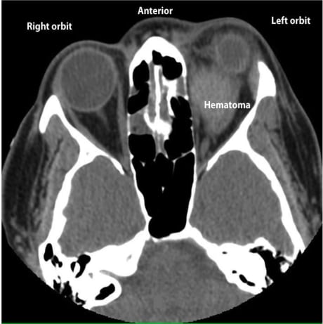 Retrobulbar Hematoma from Warfarin Toxicity and the Limitations of Bedside Ocular Sonography