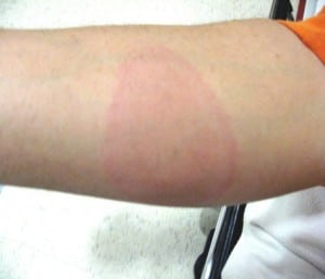 Figure 1. Extremity rash consistent with erythema migrans
